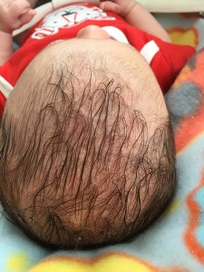 Cradle Cap